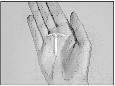 Mirena levonorgestrel-releasing intrauterine system shown in the palm of a hand — official Bayer product image